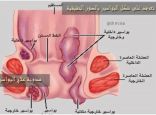 أعراض البواسير الداخلية والخارجية والمتخثرة وكيفية الوقاية